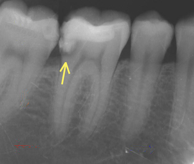 X-ray showing secondary caries under an existing restoration — the kind of finding that appears as a CDT billing code on a treatment plan