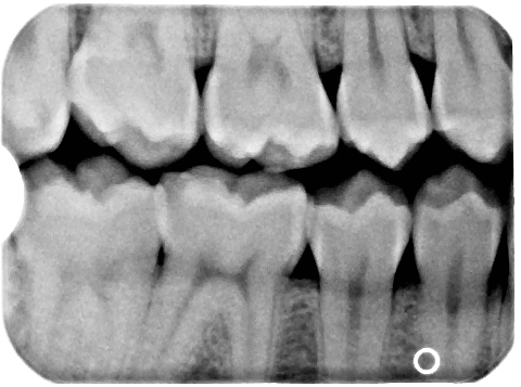 Dental X-ray showing a tooth with a large existing restoration that may require a crown rather than a filling