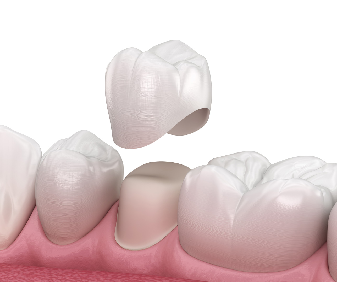 Dental crown treatment and when it's necessary