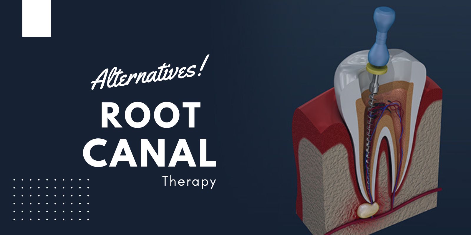 Comparing root canal treatment with alternative dental procedures