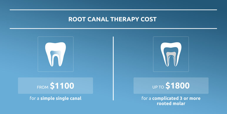 Root canal cost breakdown and pricing guide for dental patients