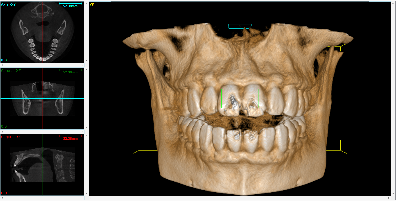 Cone beam CT (CBCT) scan showing axial, sagittal, and coronal cross-sectional views with 3D reconstruction of dental anatomy