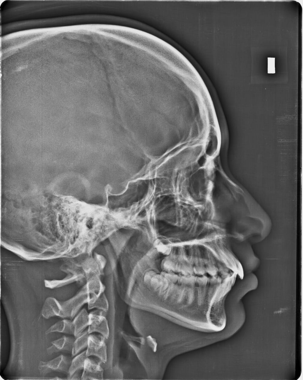 Lateral cephalometric X-ray used in orthodontic treatment planning
