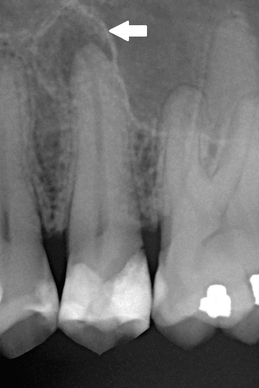 Dental X-ray of a second premolar showing chronic apical periodontitis with periapical radiolucency at the root apex
