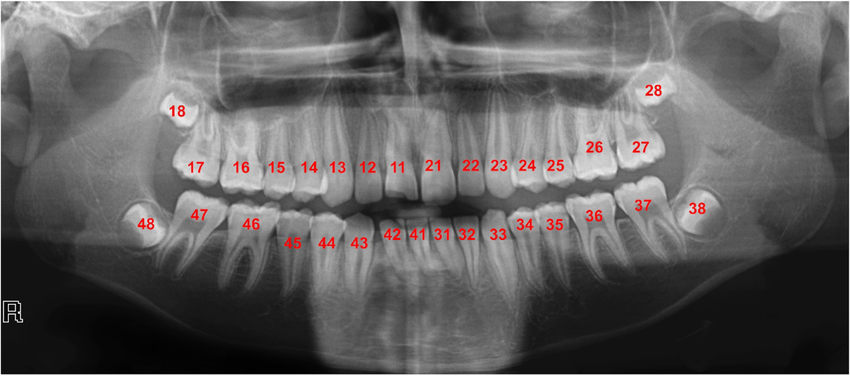 Panoramic dental X-ray labelled with the FDI two-digit notation