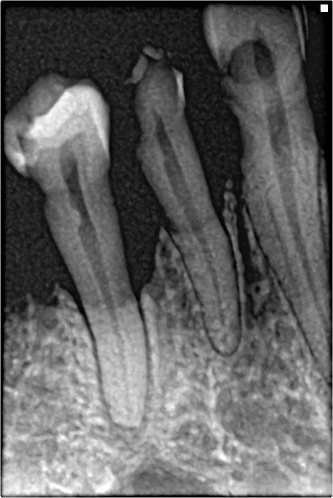 Dental X-ray showing periodontal bone loss with reduced crestal bone level visible across multiple teeth