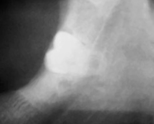 Panoramic dental X-ray showing an impacted lower third molar (wisdom tooth) positioned in close proximity to the inferior alveolar nerve
