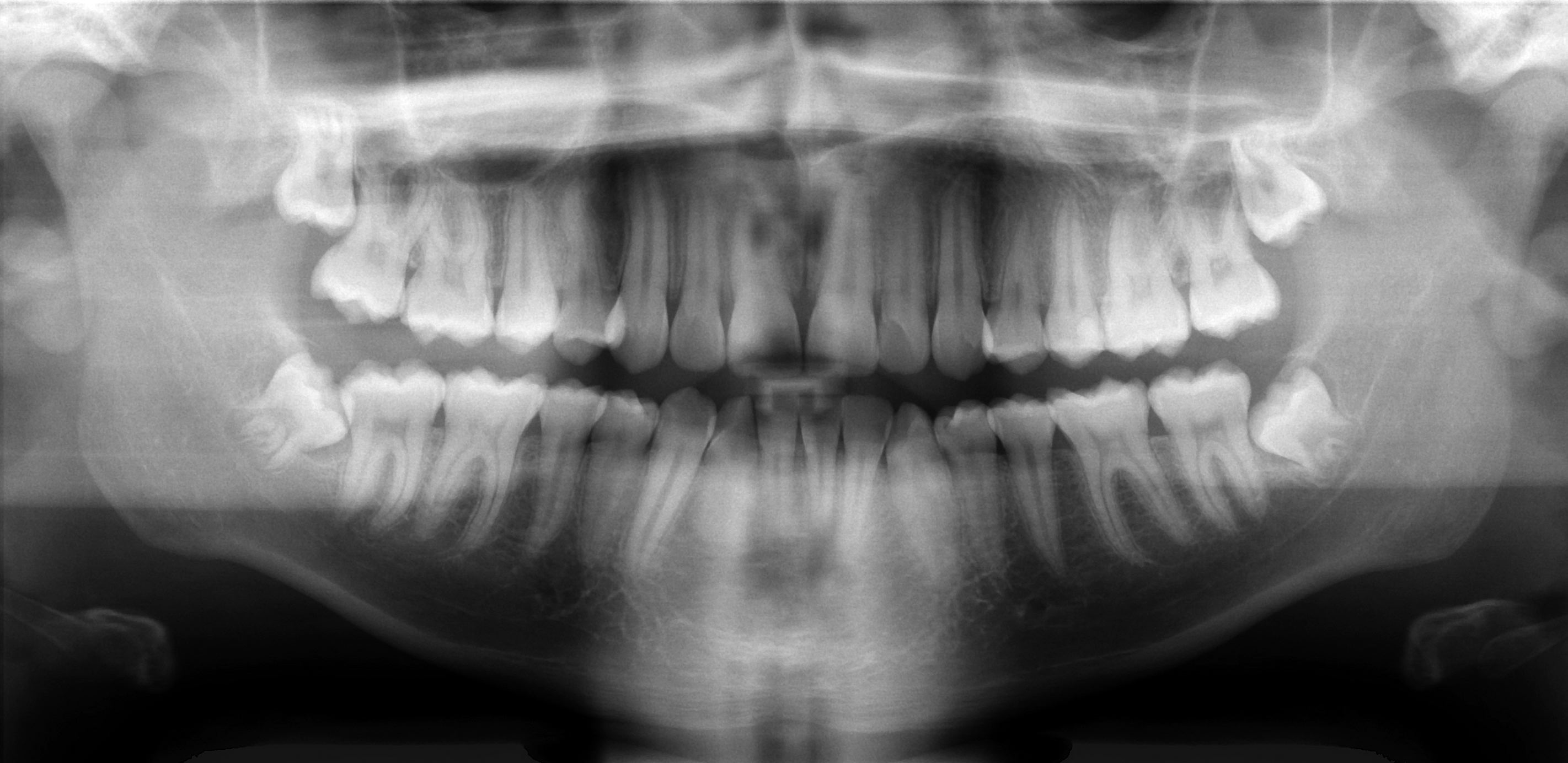 Panoramic dental X-ray (OPG) showing both jaws, all teeth, and the surrounding anatomy in a single image