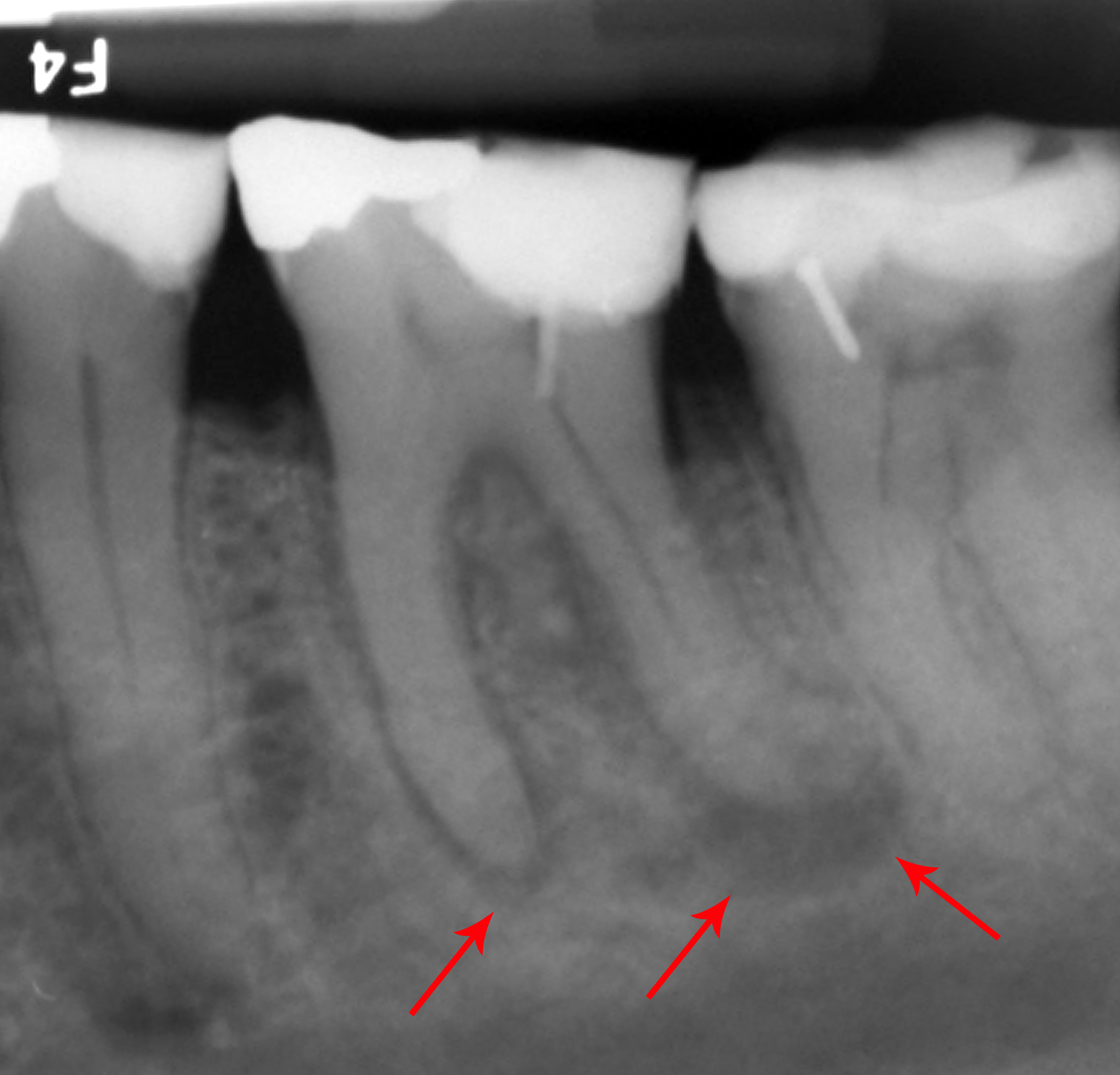 Periapical dental X-ray showing a tooth with periapical abscess affecting both roots