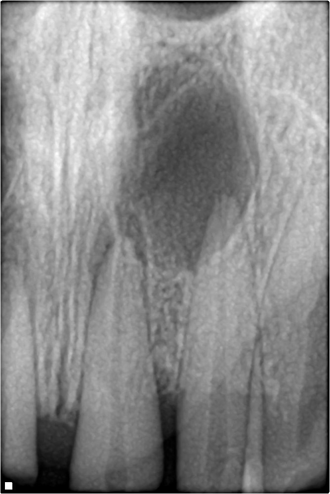 Periapical dental X-ray showing periradicular radiolucency and bone loss at the apex of anterior teeth indicating periapical pathology