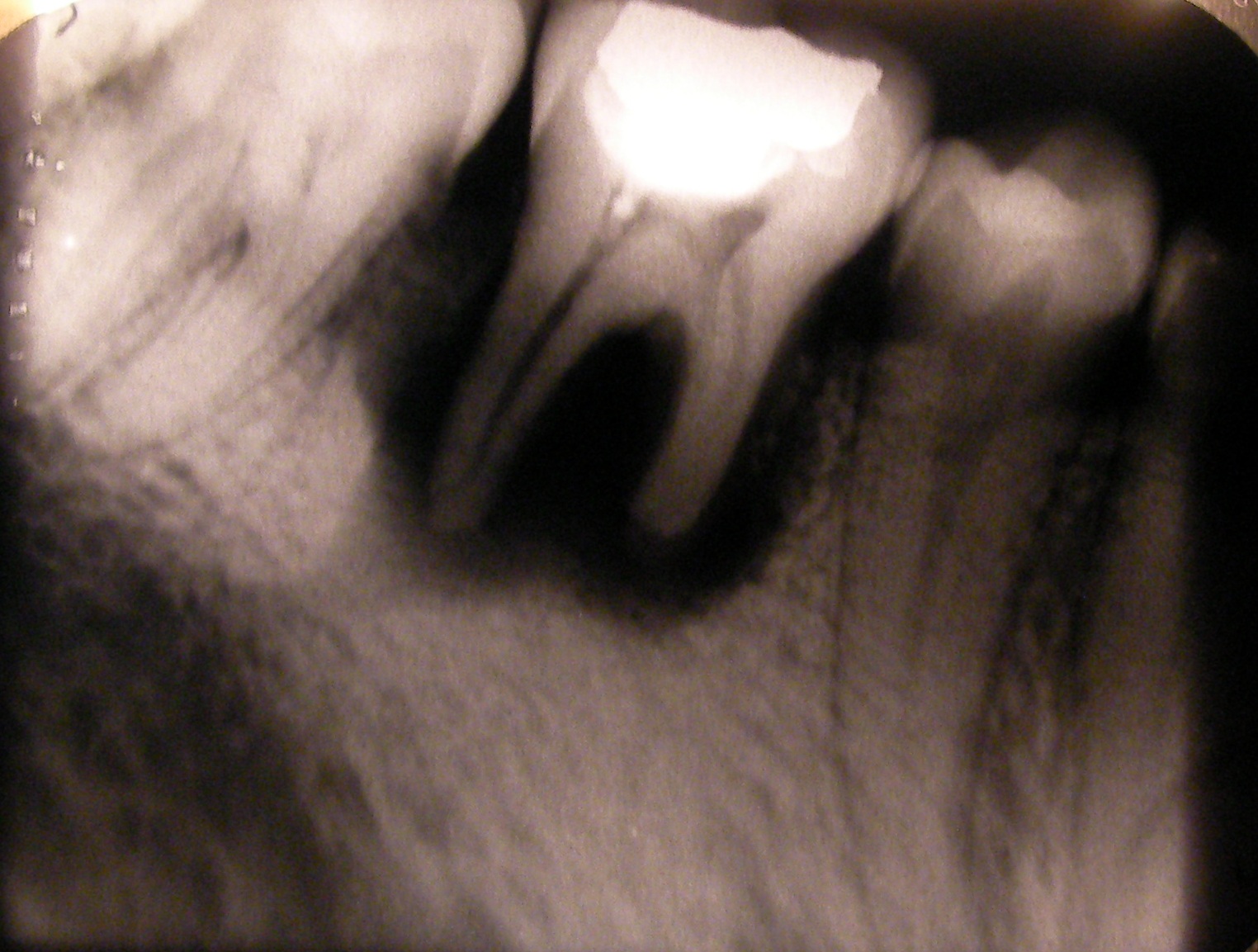 Dental X-ray showing root resorption with loss of root structure visible on the affected tooth