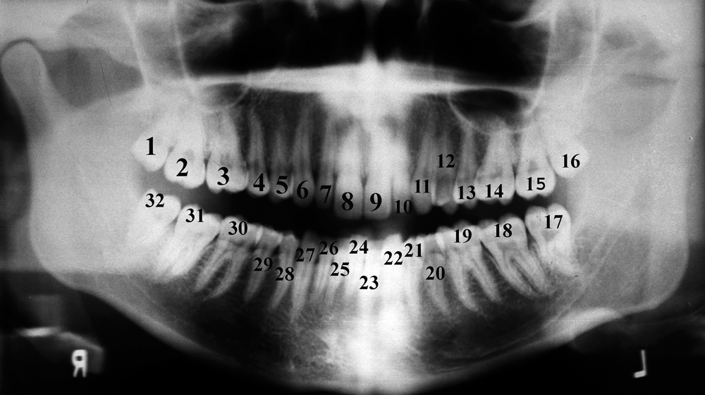 A panoramic dental X-ray with every tooth labelled by number